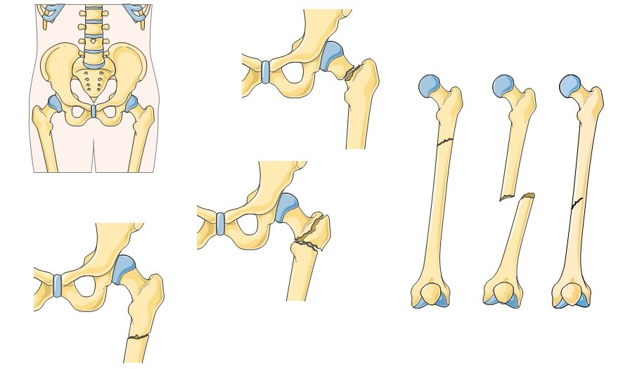 Illustration depicting common fracture locations of femur