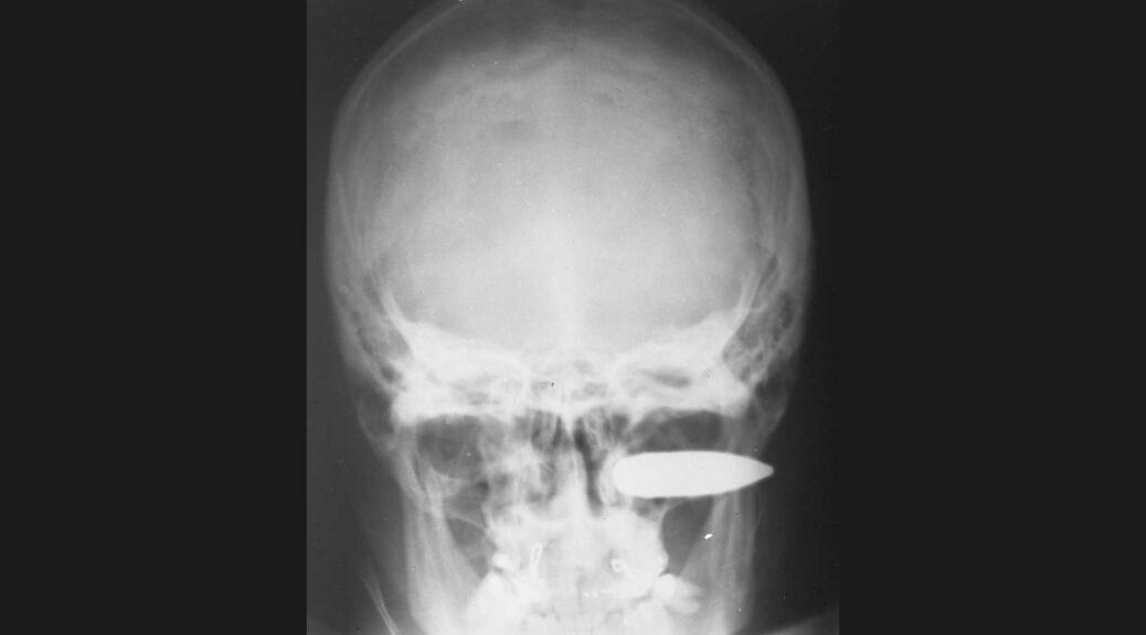 X-ray image of a bullet lodged in a human skull.
